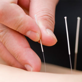 acupunturista fazendo acupuntura nas costas de um idoso