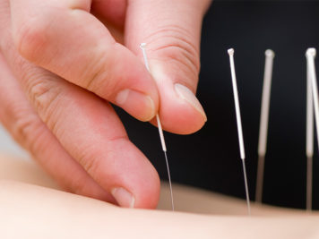 acupunturista fazendo acupuntura nas costas de um idoso